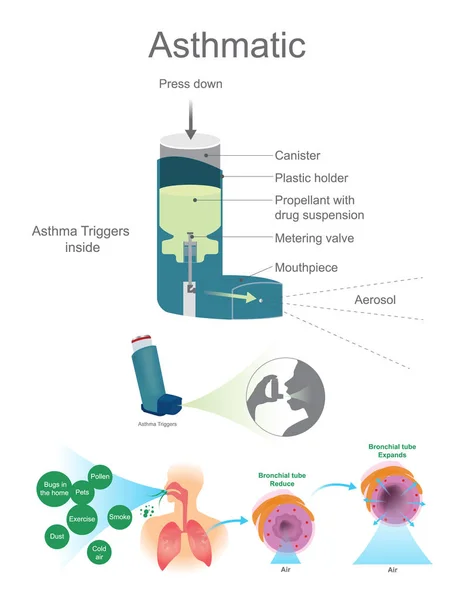 Astmatiska luftvägarna. Astma utlösare inuti Visa. — Stock vektor