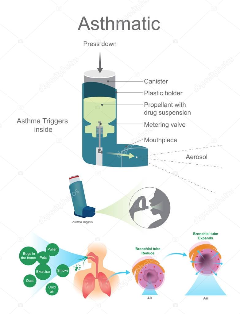 Asthmatic Airway. Asthma Triggers inside view.