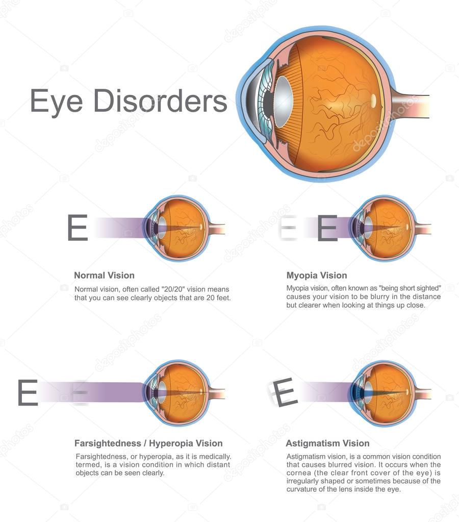 Eye disorders. Vector graphic.