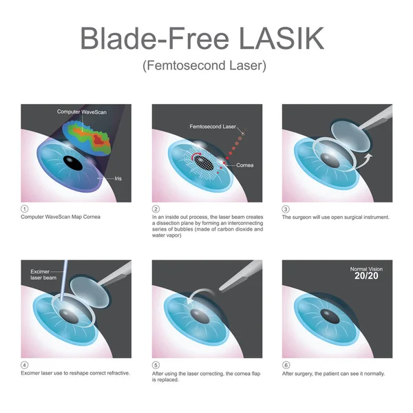 LASIK livre da lâmina. Gráfico vetorial . — Vetor de Stock