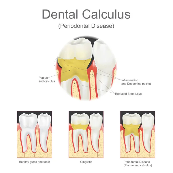 Dental calculus periodontal disease. — Stock Vector