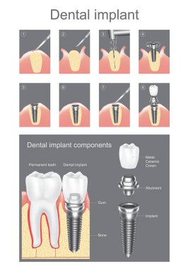 Diş implantı. Vektör grafik tasarım.