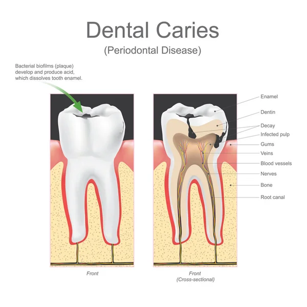 Dental caries periodontal disease. — Stock Vector