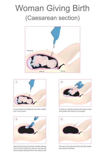 여성 출산 (제왕 절 개)입니다. 벡터 그래픽. — 스톡 벡터