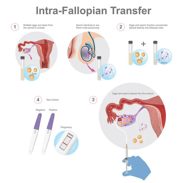 Transferência intra-falópio — Vetor de Stock