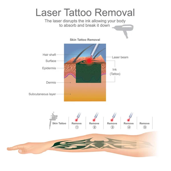 L'enlèvement de tatouage est le plus souvent effectué à l'aide de lasers qui décomposent les particules d'encre dans le tatouage. Infographie éducative. Conception vectorielle . — Image vectorielle