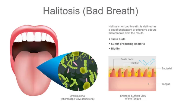 Halitosis (slechte adem). Onderwijs info afbeelding. Vector design. — Stockvector