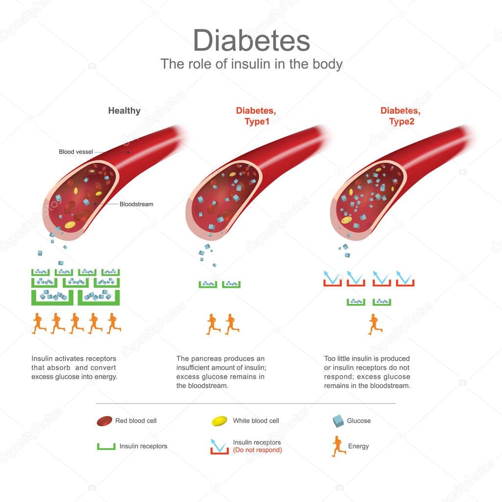 Diabetes. Health care info graphic. Vector design.