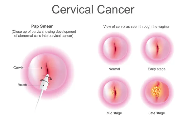 Fase van baarmoederhalskanker. Onderwijs info grafische vector. — Stockvector