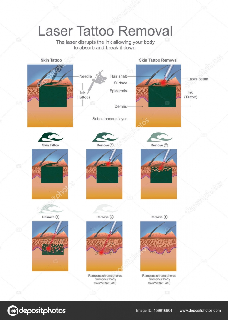 Tattoo removal Vector Art Stock Images | Depositphotos Tattoo removal Vector Art Stock Images | Depositphotos