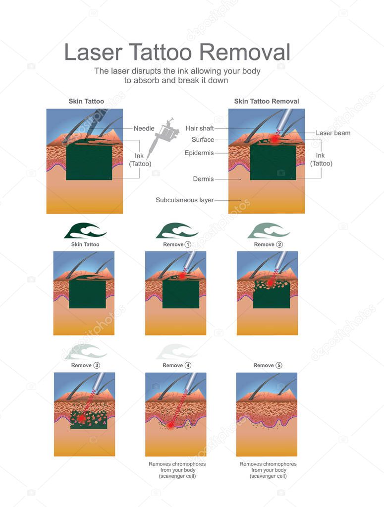 Laser Tattoo Removal