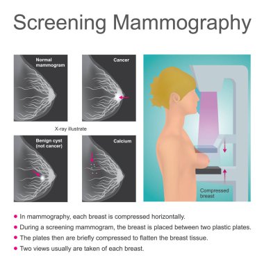 Mamografi eleme. Vektör grafiği.