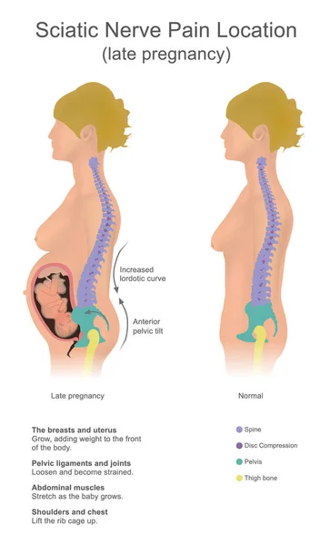 Locatio nyeri saraf Sciatic - Stok Vektor