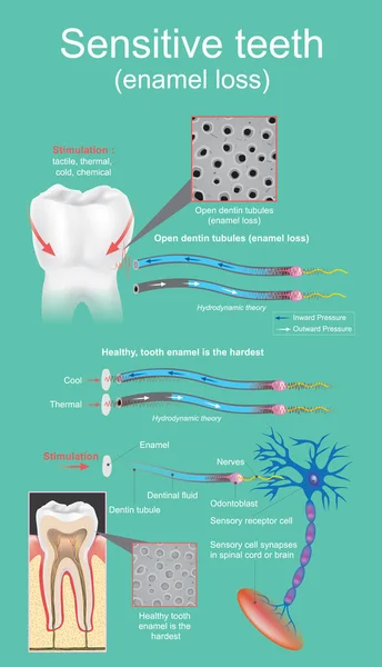 El dolor dental sensible se define como el dolor intenso y transitorio que es causado por la exposición de la dentina. Diseño gráfico vectorial . — Archivo Imágenes Vectoriales