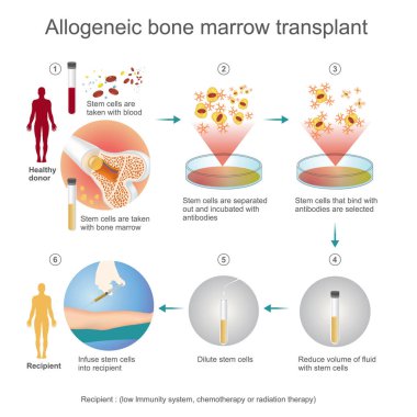 The allogeneic transplant process. clipart