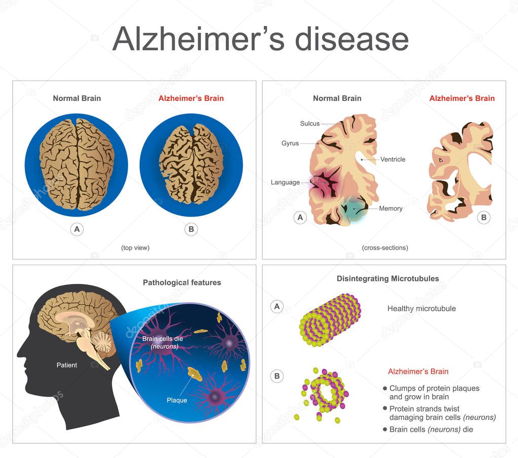 Alzheimers disease. Brain cells die, neuron diseased, certain areas of brain shrink memory loss or changes in memory for people at risk could affect younger people. Info graphic vector.