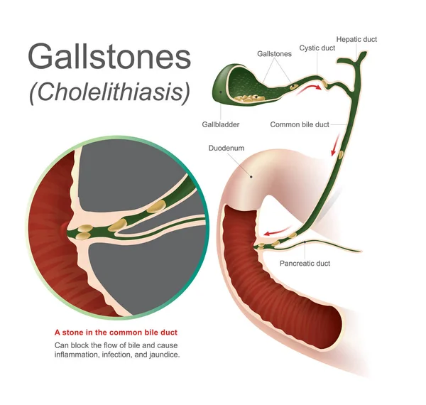 Colelitiasis de cálculos biliares. Un cálculo en el conducto biliar común, cálculos biliares pueden bloquear el flujo de bilis y causar infección por inflamación e ictericia, Info gráfico Vector . — Vector de stock