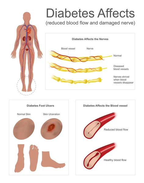 La diabetes afecta los nervios y los vasos sanguíneos — Vector de stock