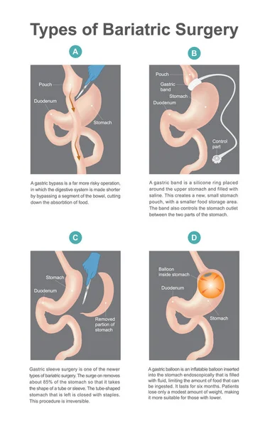 Tipos de cirugía bariátrica, es el proceso para el sistema digestivo en el estómago, Un nuevo tipo de cirugía bariátrica resultado en los pacientes pierden solo de peso. Parte del cuerpo humano . — Vector de stock