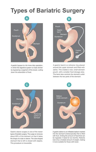 Bariatric 수술의 종류, 그것은 위장에서 소화 시스템에 대 한 과정, 새로운 유형의 환자에 bariatric 수술 결과 무게의 손실. 인간의 신체의 일부. — 스톡 벡터