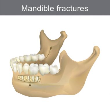 Mandibula kırıkları olan en büyük, en güçlü ve en düşük kemik 