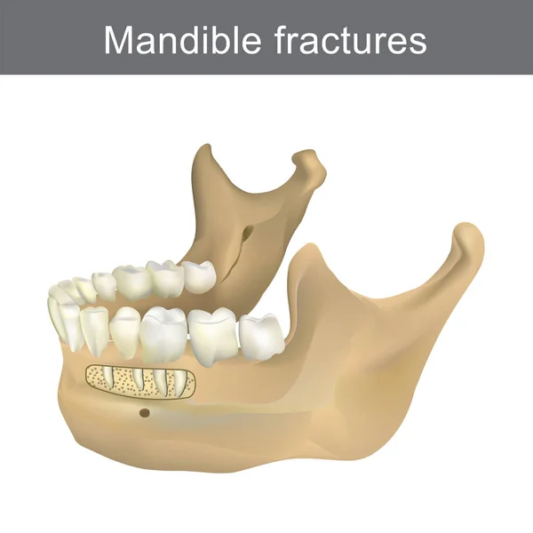 Mandible fractures is the largest, strongest and lowest bone in — Stock Vector