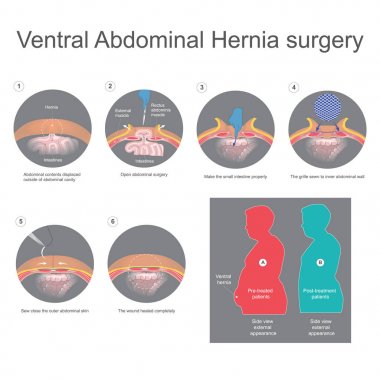 Ventral fıtık weakn bir açılış dokuların bir çıkıntı olduğunu