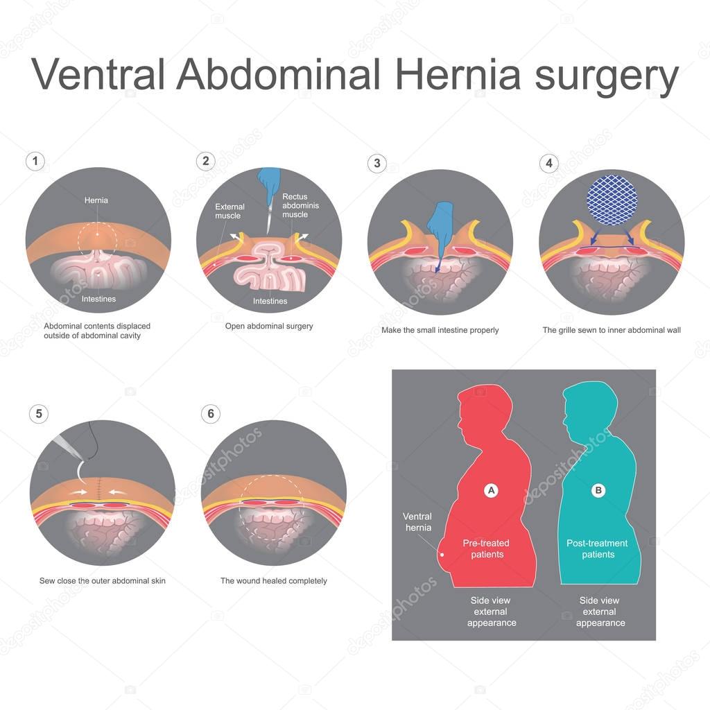 Ventral hernia is a bulge of tissues through an opening of weakn