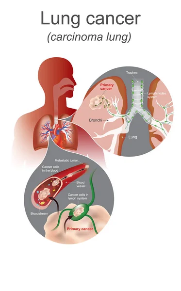 肺癌是肺的恶性肺肿瘤细胞生长失控组织中的特点。肺系统，呼吸系统。图的图形。吸烟是肺癌的主要贡献. — 图库矢量图片