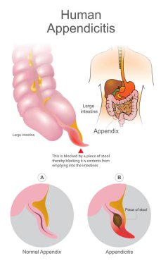 Human Appendicitis. A blocked by a piece of stool thereby blocking it is contents from emptying into intestines. Large Intestine system. Illustration human body parts. clipart