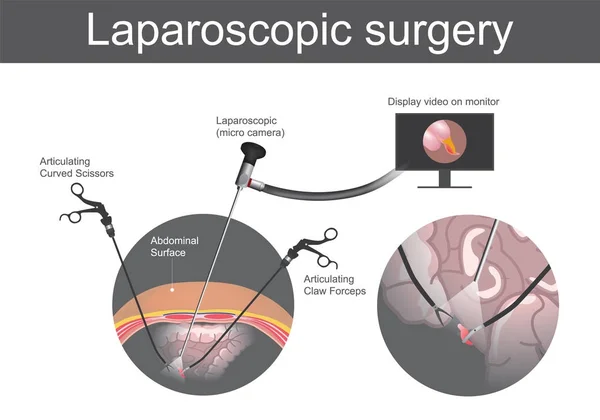 Laparoskopische Chirurgie. Dickdarmsystem. Abbildung menschlicher Körperteile. — Stockvektor