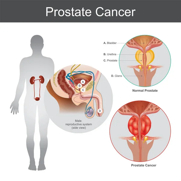 प्रोस्टेट कर्करोग. स्पष्टीकरण शरीर भाग . — स्टॉक फोटो, इमेज