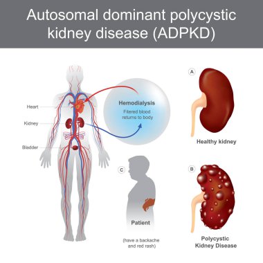 Autosomal Dominant Polycystic Kidney Disease. clipart