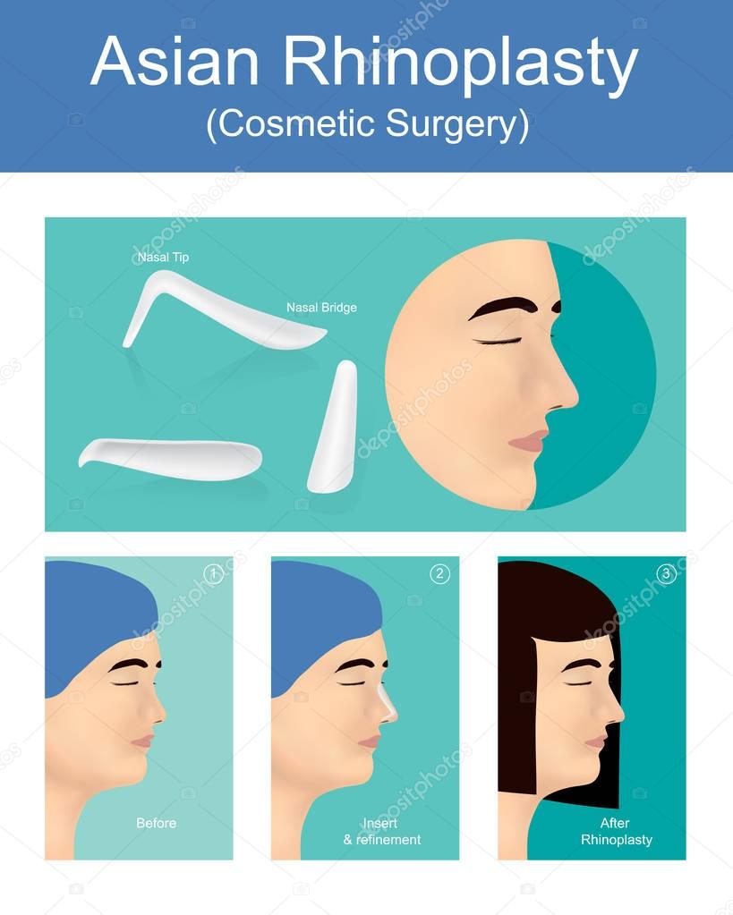 Rhinoplasty is a  plastic surgery. Illustration vector.