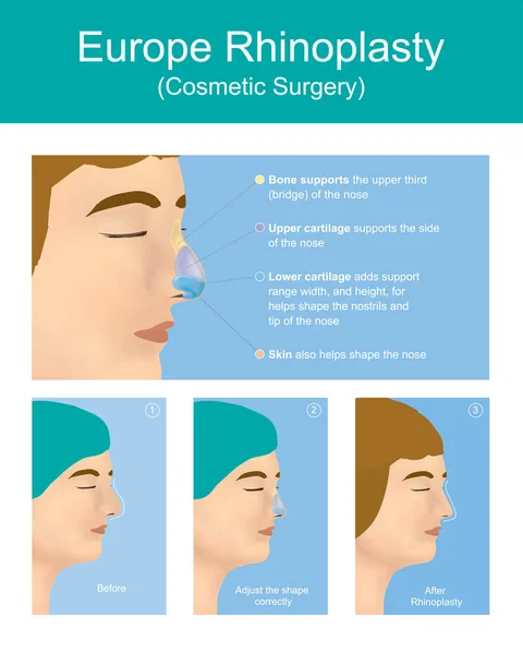 Rhinoplastie chirurgie plastique . — Image vectorielle