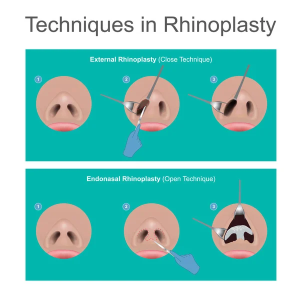 Techniques de rhinoplastie . — Image vectorielle