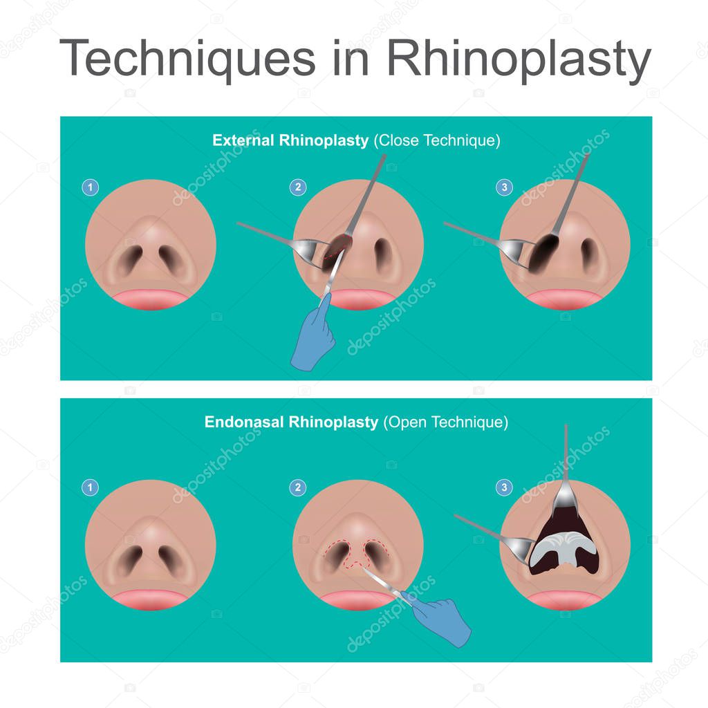Techniques in rhinoplasty.