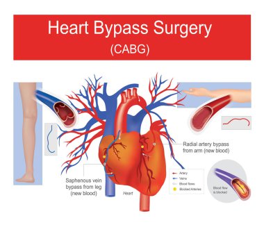 Heart bypass surgery. clipart