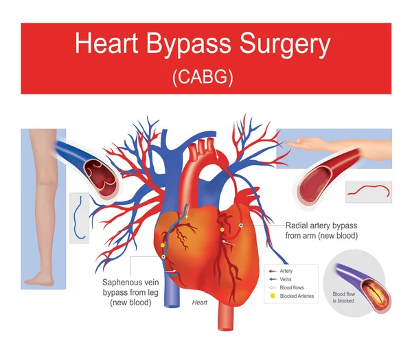 Cirurgia de bypass cardíaco . — Vetor de Stock