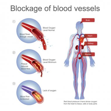 Blockage of blood Vessels. clipart