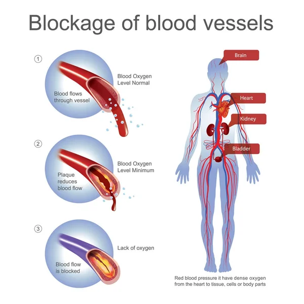 血管堵塞. — 图库矢量图片