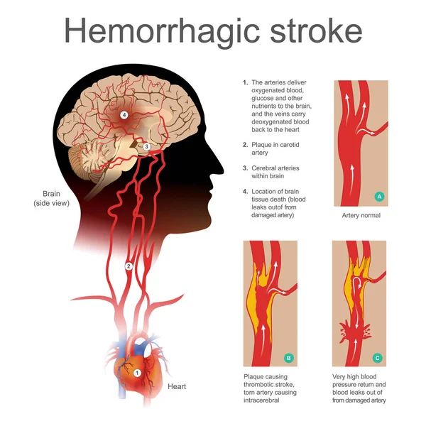 Un derrame hemorrágico. Placa que causa accidente cerebrovascular trombótico arteria rota causando intracerebral . — Vector de stock