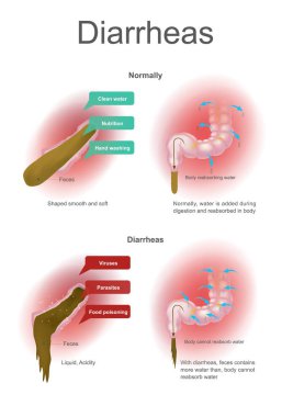 Diarrheas. Normal su sindirim sırasında eklenir ve vücutta emilir. Diarrheas vücut daha ile su emmek olamaz. Resimde kolon.