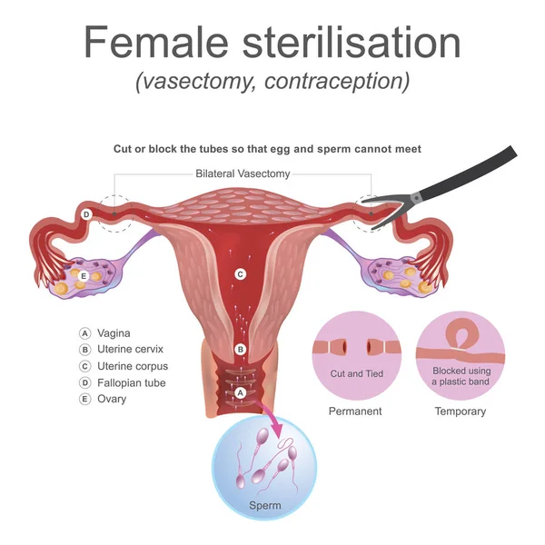 Vasectomie de stérilisation féminine. Le système reproducteur masculin ceux-ci travaillent ensemble pour produire du sperme . — Image vectorielle