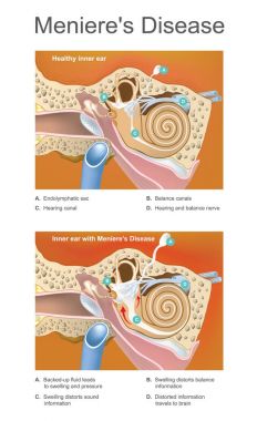 Meniere disease. Illustration. Disorder of the inner ear that ca clipart
