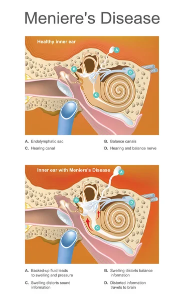 Meniere disease. Illustration. Disorder of the inner ear that ca — Stock Vector