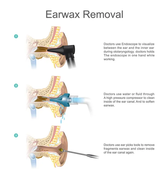 Remoção de cera. EARWAX é um problema comum que é facilmente tratado — Vetor de Stock