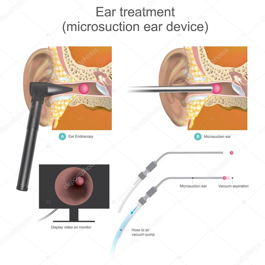 The Micro suction ear device it is vacuum working system