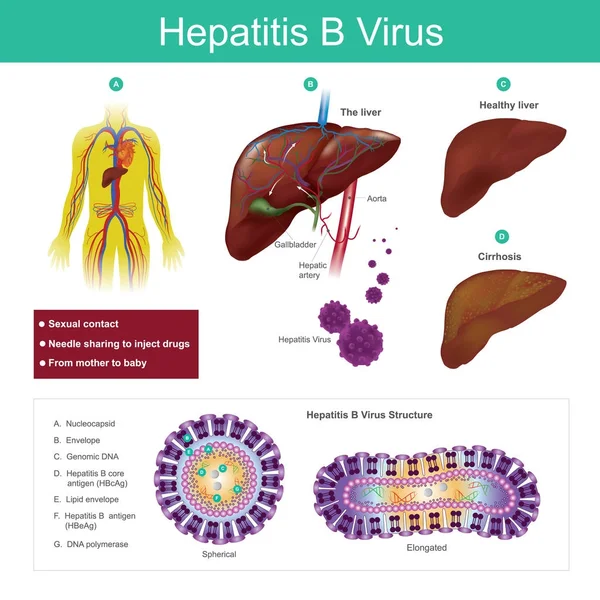 Vírus da hepatite B. O vírus é transmitido principalmente por sexual . —  Vetores de Stock