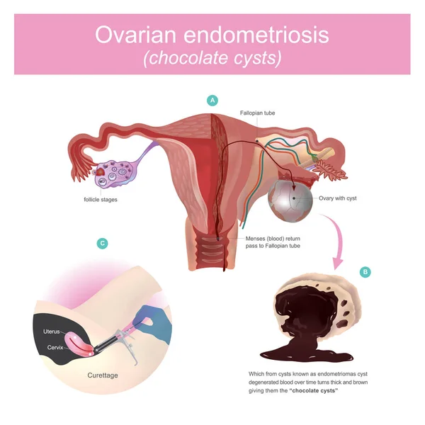 Ovarian endometriosis  chocolate cysts. — Stock Vector